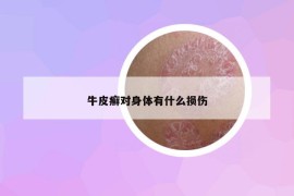 牛皮癣对身体有什么损伤