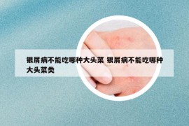 银屑病不能吃哪种大头菜 银屑病不能吃哪种大头菜类