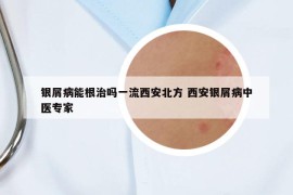 银屑病能根治吗一流西安北方 西安银屑病中医专家