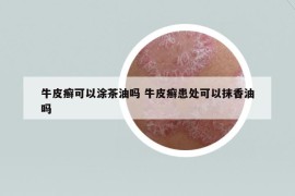 牛皮癣可以涂茶油吗 牛皮癣患处可以抹香油吗