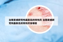 治银屑病研究所最新出的特效药 治银屑病研究所最新出的特效药有哪些