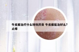 牛皮廨治疗什么特效药膏 牛皮廨能治好么?止痒