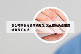 怎么预防头皮银屑病复发 怎么预防头皮银屑病复发的方法