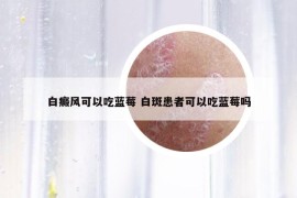 白癜风可以吃蓝莓 白斑患者可以吃蓝莓吗