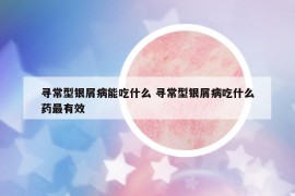 寻常型银屑病能吃什么 寻常型银屑病吃什么药最有效