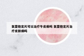 氯雷他定片可以治疗牛皮癣吗 氯雷他定片治疗皮肤病吗