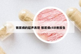 银屑病的超声表现 银屑病ct诊断报告