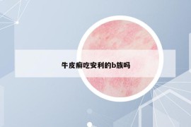 牛皮癣吃安利的b族吗