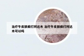 治疗牛皮肤癣打阿达木 治疗牛皮肤癣打阿达木可以吗