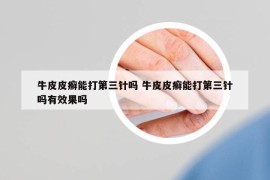 牛皮皮癣能打第三针吗 牛皮皮癣能打第三针吗有效果吗