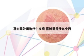 喜树果外用治疗牛皮癣 喜树果是什么中药