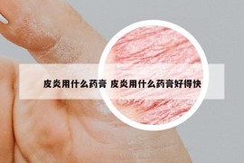 皮炎用什么药膏 皮炎用什么药膏好得快