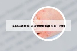头藓与银屑病 头皮型银屑病和头癣一样吗