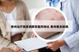 泰州治疗银屑病那家医院地址 泰州看皮肤病