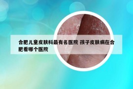 合肥儿童皮肤科最有名医院 孩子皮肤病在合肥看哪个医院