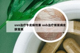 uvn治疗牛皮癣效果 uvb治疗银屑病皮肤变黑