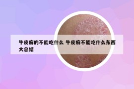 牛皮癣的不能吃什么 牛皮癣不能吃什么东西大总结