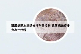 银屑病基本消退光疗剂量控制 银屑病光疗多少次一疗程
