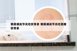 银屑病关节炎吃软骨素 银屑病关节炎吃氨糖软骨素