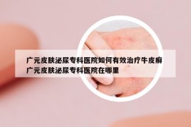 广元皮肤泌尿专科医院如何有效治疗牛皮癣 广元皮肤泌尿专科医院在哪里