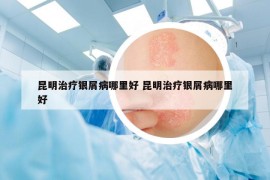 昆明治疗银屑病哪里好 昆明治疗银屑病哪里好