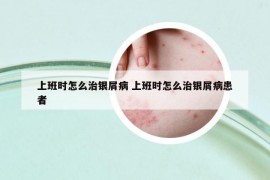 上班时怎么治银屑病 上班时怎么治银屑病患者