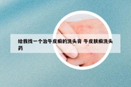 给我找一个治牛皮癣的洗头膏 牛皮肤癣洗头药
