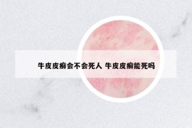 牛皮皮癣会不会死人 牛皮皮癣能死吗