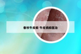春秋牛皮癣 牛皮病癣医治