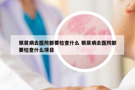 银屑病去医院都要检查什么 银屑病去医院都要检查什么项目