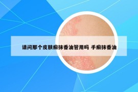 请问那个皮肤癣抹香油管用吗 手癣抹香油