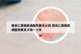 西安仁爱银屑病医院要多少钱 西安仁爱银屑病医院要多少钱一个月