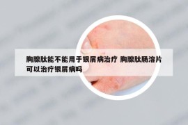 胸腺肽能不能用于银屑病治疗 胸腺肽肠溶片可以治疗银屑病吗