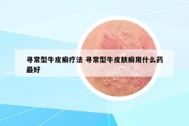 寻常型牛皮癣疗法 寻常型牛皮肤癣用什么药最好