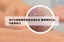 为什么银屑病不能多洗澡沐浴 银屑病为什么不能有伤口
