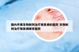 国内开展生物制剂治疗银屑病的医院 生物制剂治疗银屑病哪家医院