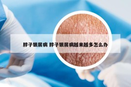 脖子银屑病 脖子银屑病越来越多怎么办