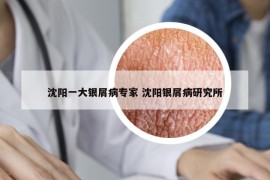 沈阳一大银屑病专家 沈阳银屑病研究所
