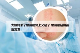 大姨妈来了银屑病背上又起了 银屑病经期前后复发