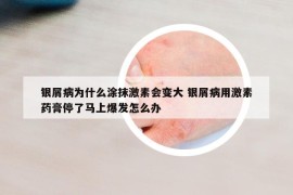 银屑病为什么涂抹激素会变大 银屑病用激素药膏停了马上爆发怎么办