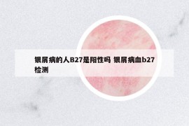 银屑病的人B27是阳性吗 银屑病血b27检测