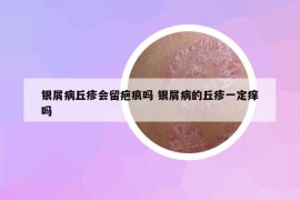 银屑病丘疹会留疤痕吗 银屑病的丘疹一定痒吗