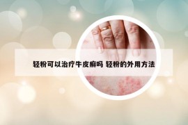 轻粉可以治疗牛皮癣吗 轻粉的外用方法