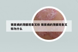 银屑病的薄膜现象又称 银屑病的薄膜现象又称为什么
