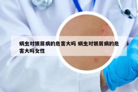 螨虫对银屑病的危害大吗 螨虫对银屑病的危害大吗女性