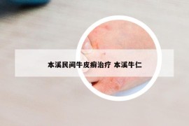 本溪民间牛皮癣治疗 本溪牛仁