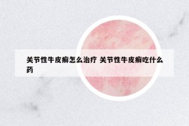 关节性牛皮癣怎么治疗 关节性牛皮癣吃什么药