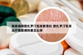 银屑病用他扎罗汀后皮肤发红 他扎罗汀乳膏治疗银屑病效果怎么样
