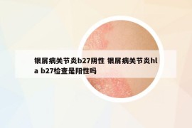 银屑病关节炎b27阴性 银屑病关节炎hla b27检查是阳性吗