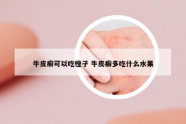 牛皮癣可以吃橙子 牛皮癣多吃什么水果